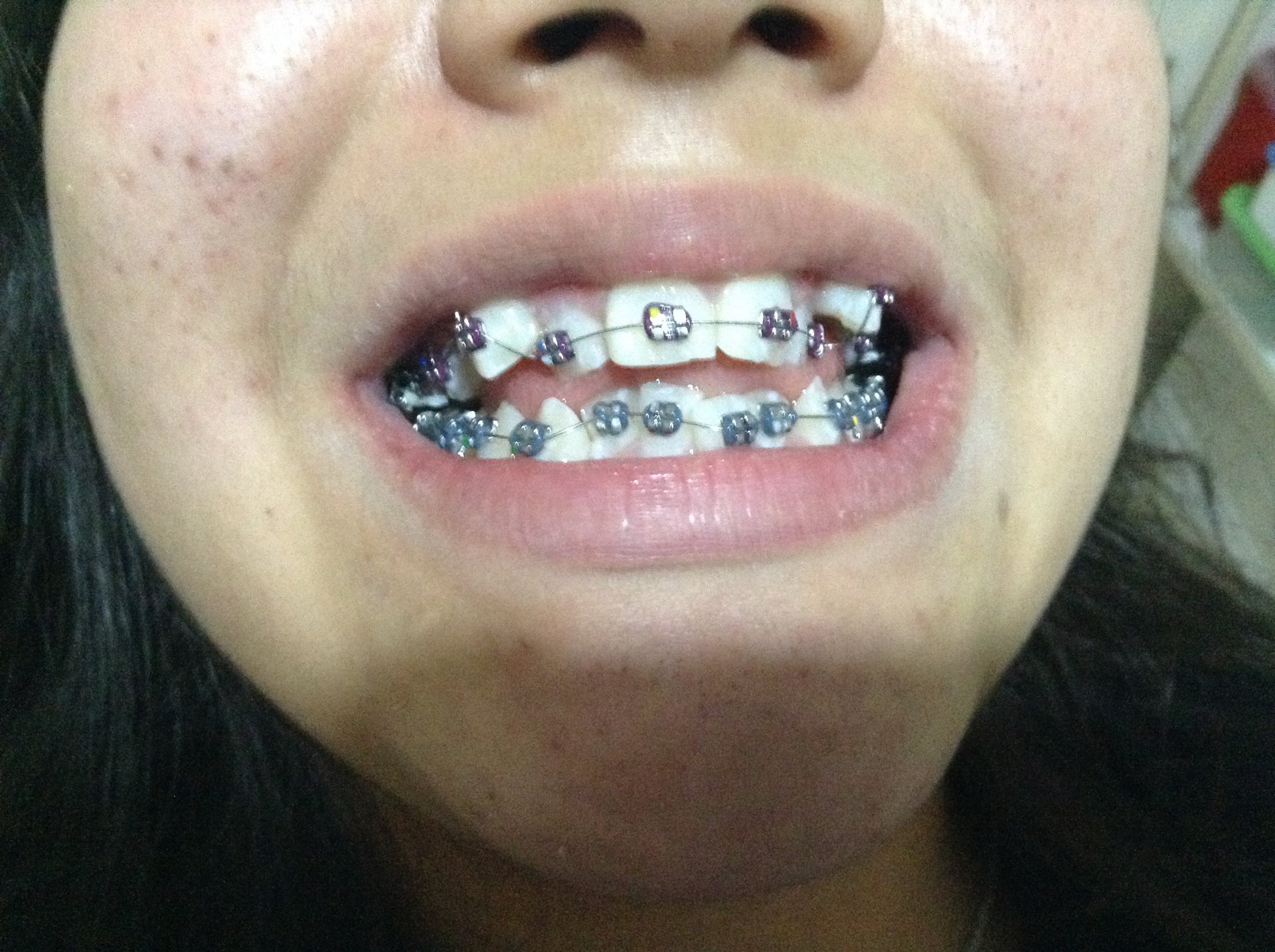 1.- Este caso es de una jovencita de 14 años que se presenta con apiñamiento severo y se le realizaron extracciones en la parte superior innecesarias