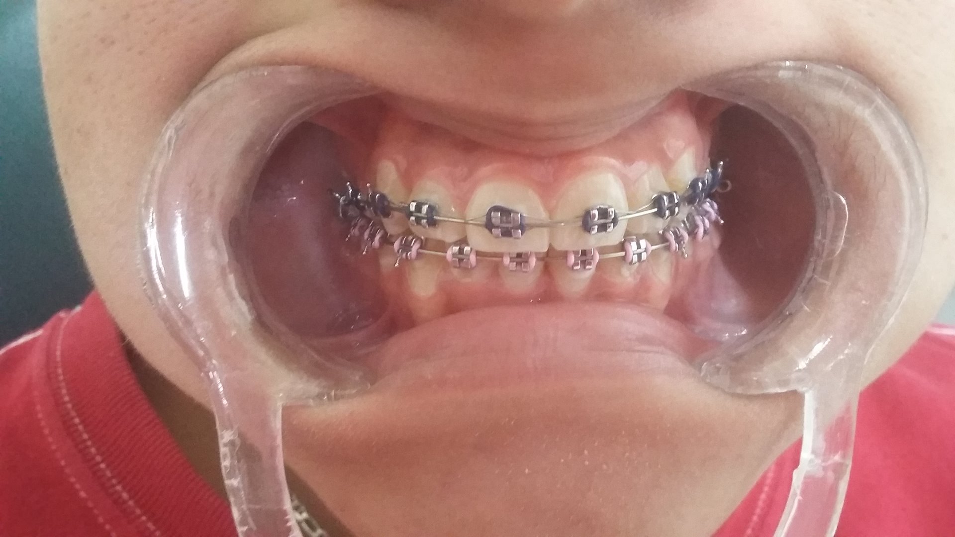 1.- 11 meses despues con tratamiento de brackets y uso de elasticos intraorales, hemos logrado alinear y cerrar los espacios para exitar el uso de protesis dentales