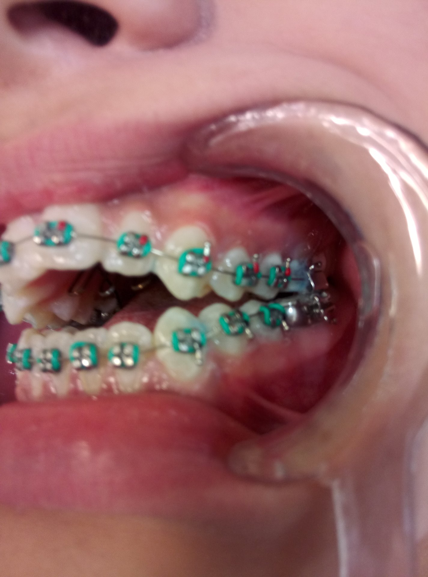 2.- Paciente de 16 años que asiste por esta severa mordida abierta debido a un habito de dedo, es decir se chupa su dedo y esto ocasiono que la mordida se abriera