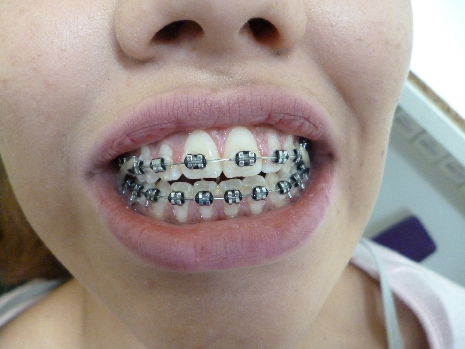 2.- Despues de 4 meses de tratamiento con el uso de una trampa para evitar que su dedo siga abriendo tenemos unos maravillosos resultados